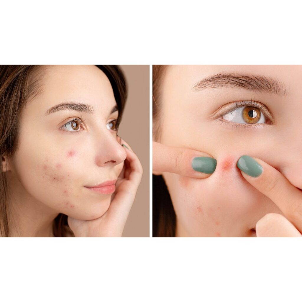   alt="Close-up of facial skin showing visible acne spots, redness, and texture for skincare reference." 
